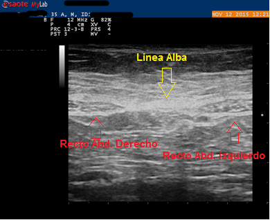 Imagen 3. Ecografía 2D de diástasis abdominal leve, realizada desde la Unidad de Suelo Pélvico de Balance Sport Clinic.